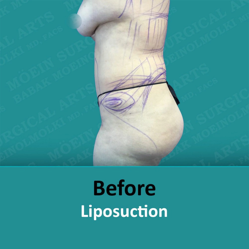 A woman's abdomen showing the transformation after undergoing liposuction.