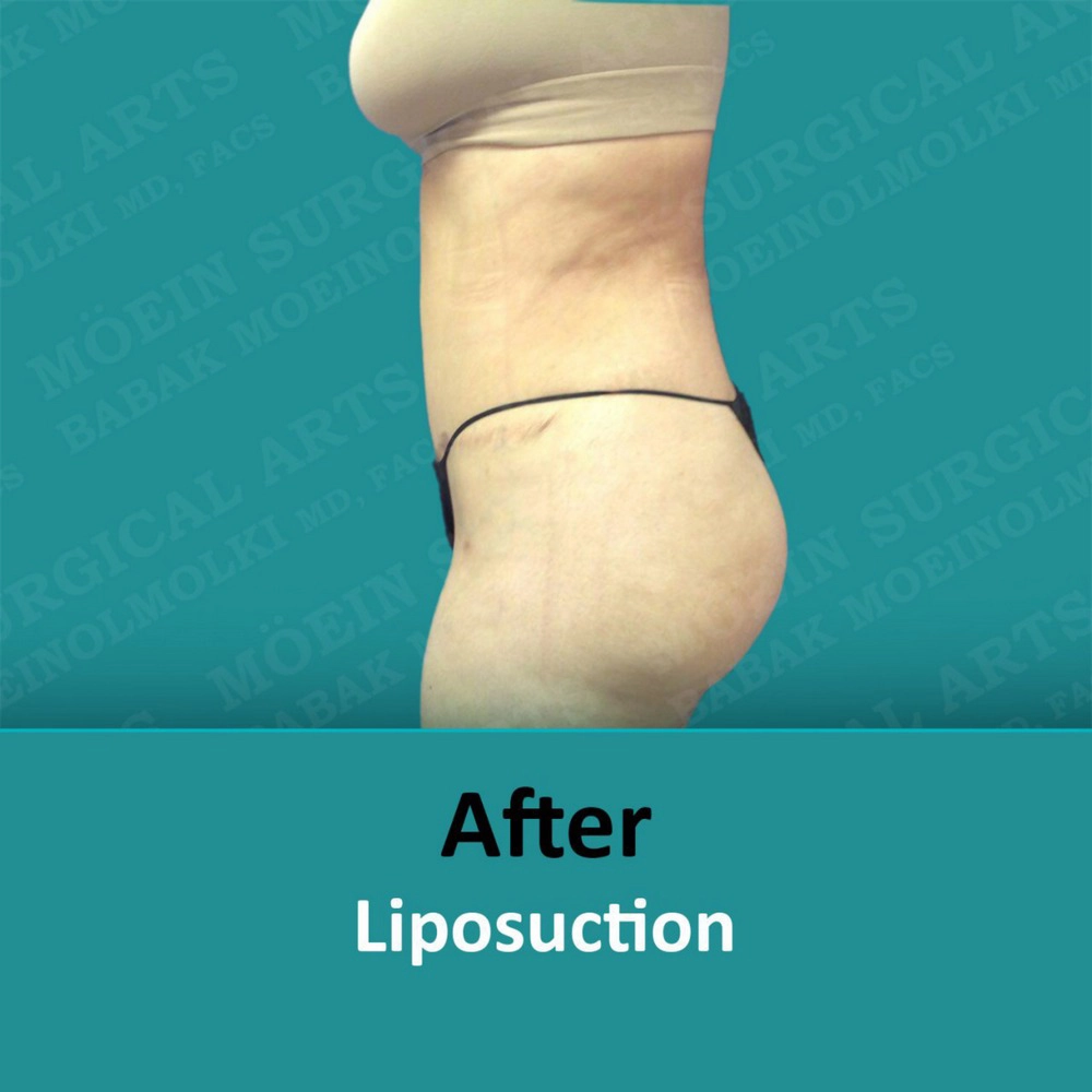 Transformation: A woman flaunts her bikini-ready figure after undergoing liposuction, showcasing the remarkable before and after results.