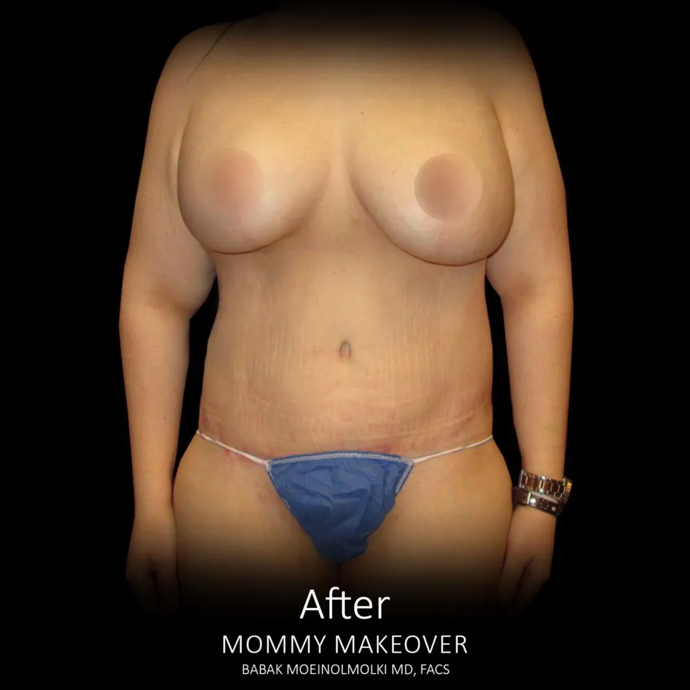 A woman's breast transformation before and after undergoing mommy makeover surgery.