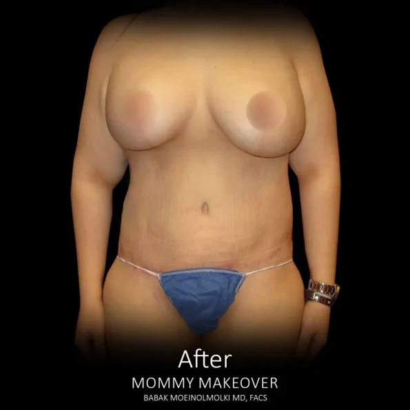 A woman's breast transformation through liposuction surgery.