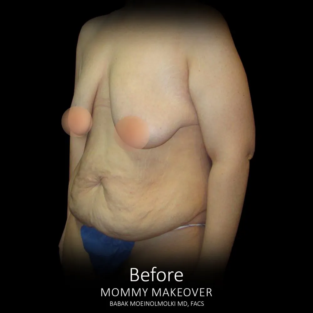 A woman's breast transformation before and after a Mommy Makeover surgery.