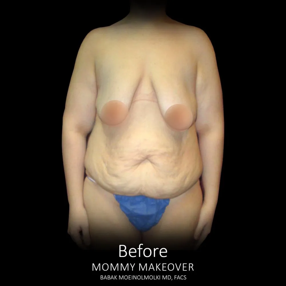 A woman's breast before and after Mommy Makeover surgery.