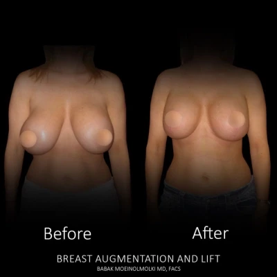 Before and after images showcasing breast augmentation combined with a lift for improved appearance.