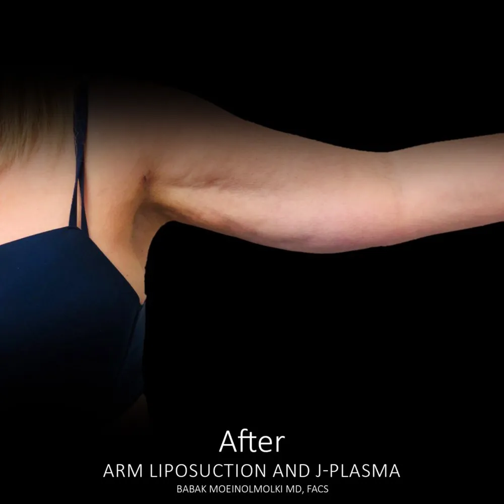 Arm liposuction before and after upplasia.