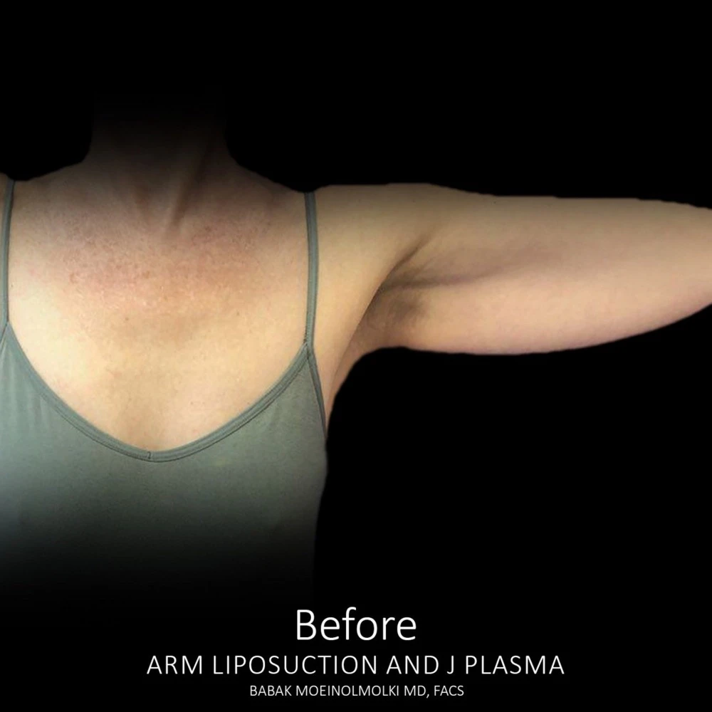 Arm liposuction before and after photos showcase the results of uiplasia treatment.