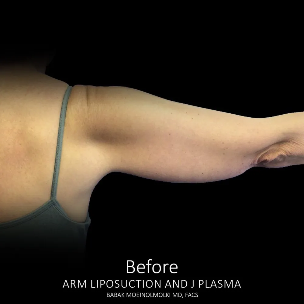 Arm liposuction and plastic surgery before and after results.