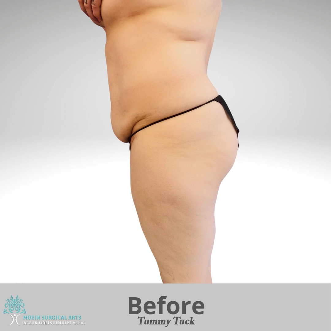 Tummy-Tuck-Surgery-before copia