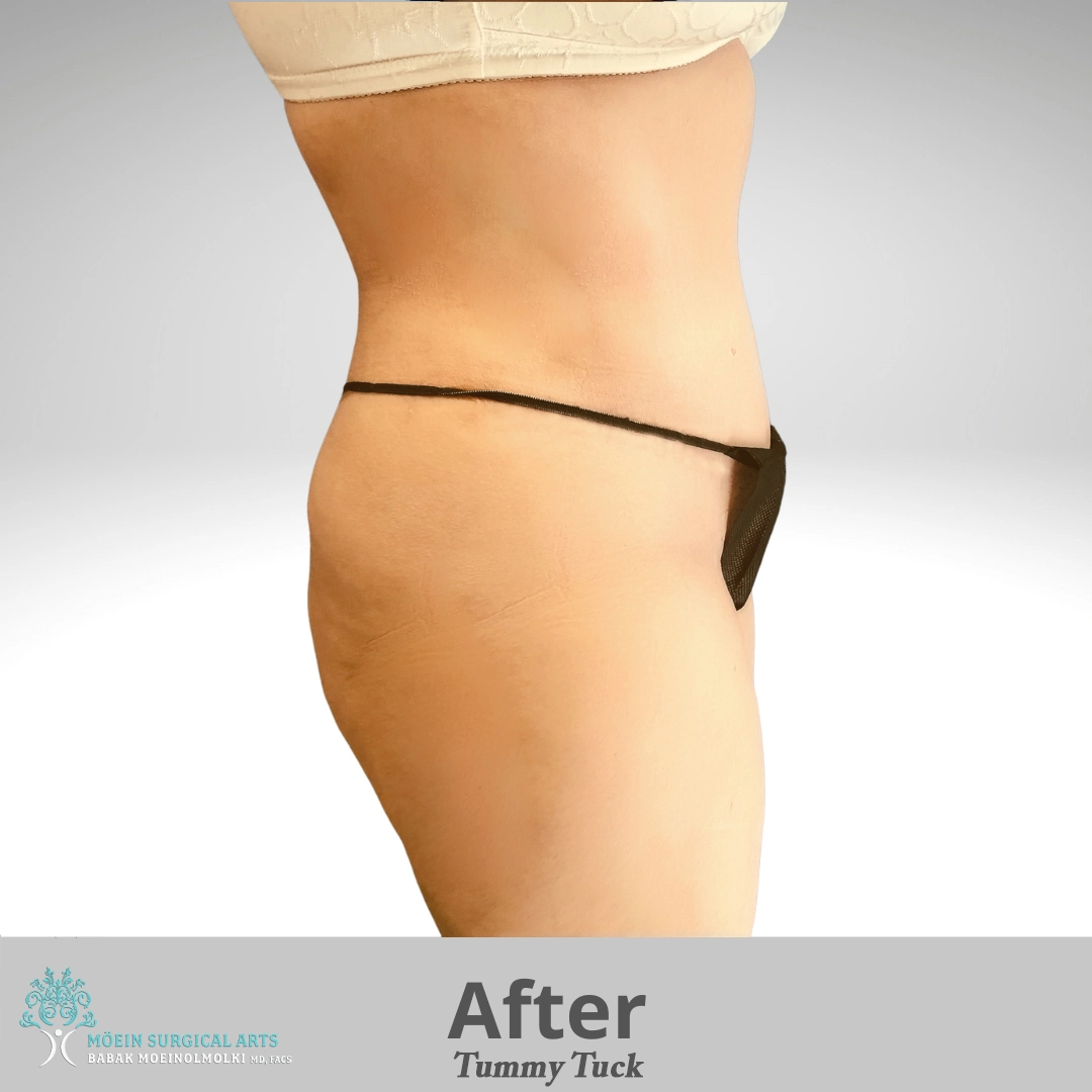 Tummy-Tuck-after copia