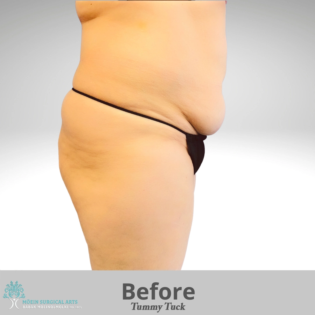 Tummy-Tuck-before copia