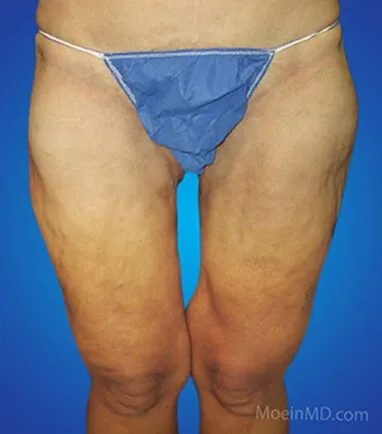 A woman's thigh transformation before and after liposuction: Thigh Lift - Liposuction Results.