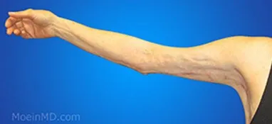 A man's arm undergoing plastic surgery.