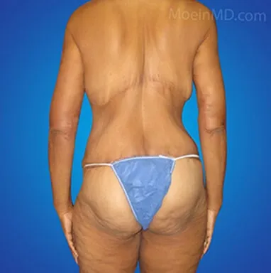 Tummy tuck transformation showcased through body lift before and after visuals.