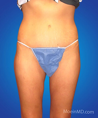 Before and after pictures of a woman's tummy following liposuction.