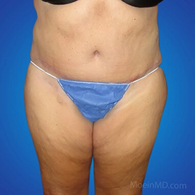 Tummy tuck and liposuction before and after.