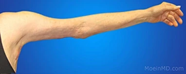 A man's arm before and after arm liposuction.