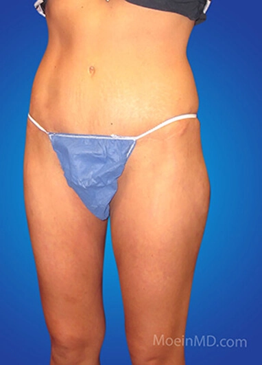 A woman's before and after tummy following liposuction.