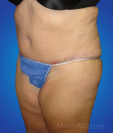 Patient before undergoing tummy tuck and liposuction procedure.