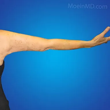 A woman's arm showcasing the transformation achieved through arm liposuction.