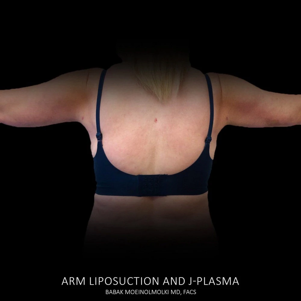 Arm liposuction before and after.