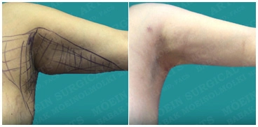 Arm Liposuction Transformation