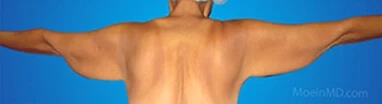 A man showcasing his transformed arms in front of a blue background after arm liposuction.