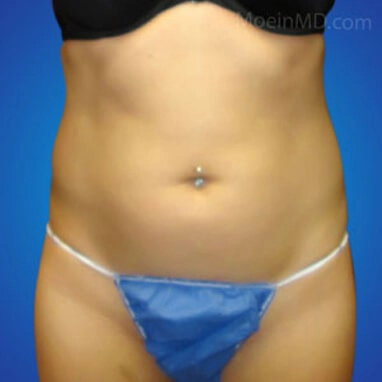 Tummy tuck and liposuction before image.