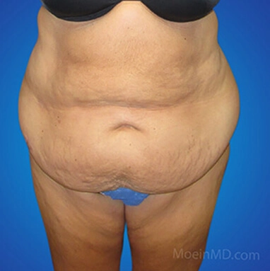 Tummy tuck and liposuction before and after.