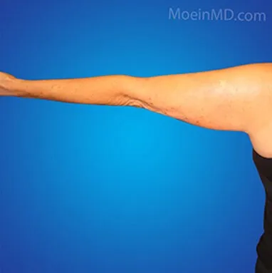 A woman's arm transformation with liposuction.