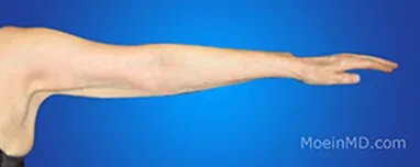 A woman's arm showcasing visible changes before and after undergoing liposuction.