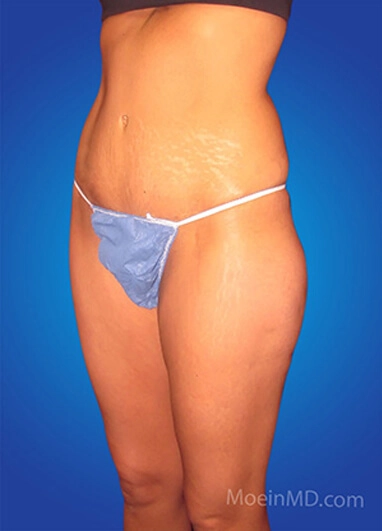A woman's post-liposuction abdomen transformation.
