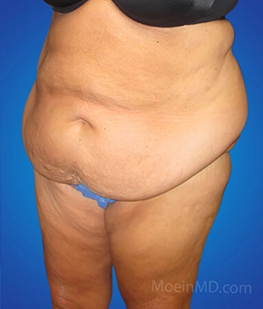 Tummy tuck and liposuction before and after transformations.