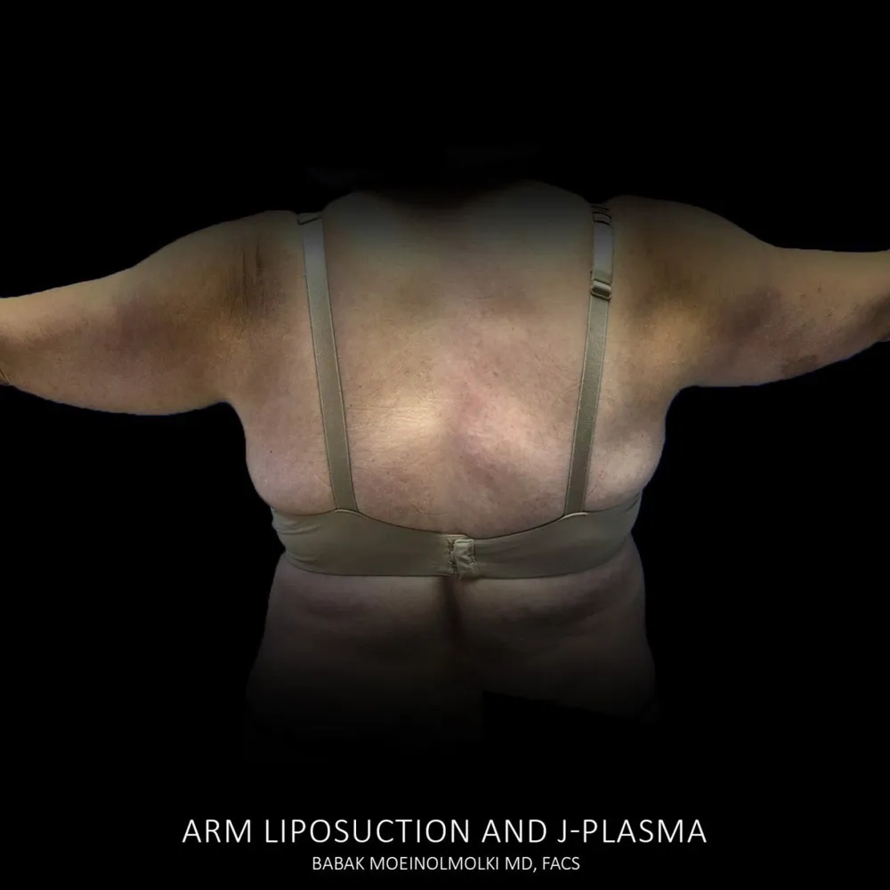 Before and after pictures of arm liposuction.