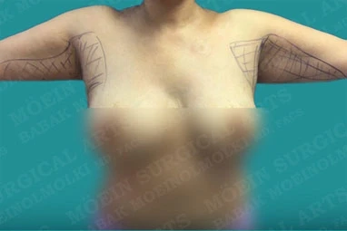 A woman's breast before and after arm liposuction surgery.