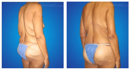 Tummy tuck and body lift before and after.