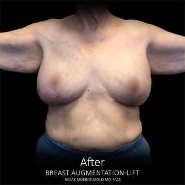breast-augmentation-and-lift-a01 copia