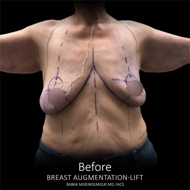 breast-augmentation-and-lift-b01 copia