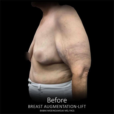 breast-augmentation-and-lift-b02 copia