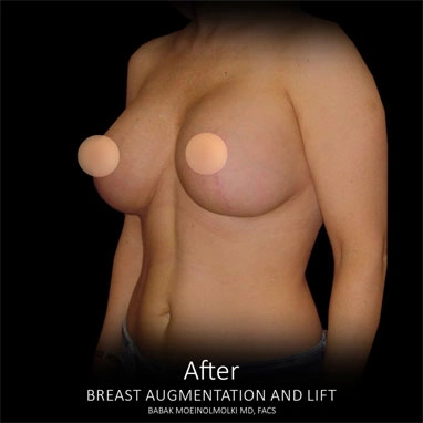 breast-lift-14 copia