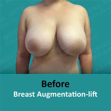 Breast augmentation and lift showcasing before and after transformation.