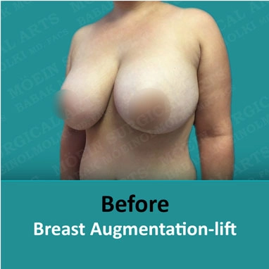 breast-lift03 copia