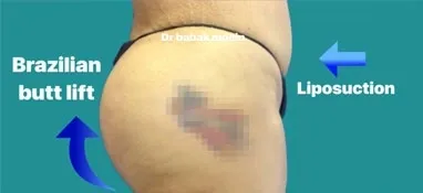 Brazilian Butt Lift - enhancing the buttocks through liposuction procedure.