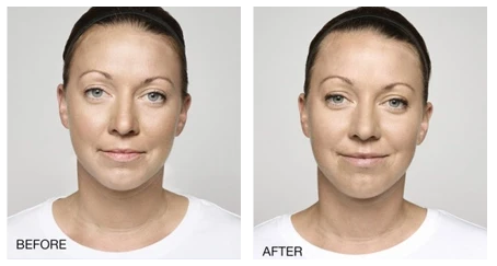 A woman's face before and after dermal fillers.