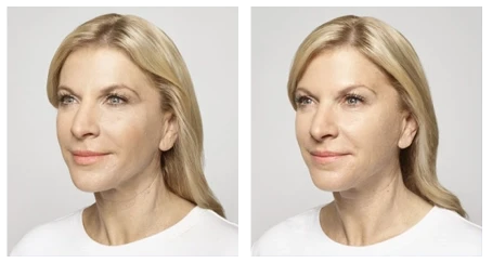 A woman's face transformation featuring dermal fillers before and after liposuction.