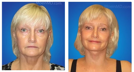 Neck Lift Before and After in LA