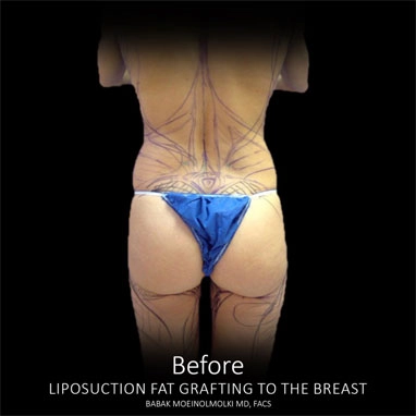 A bikini-clad woman before undergoing liposuction for a transformative before-and-after experience.