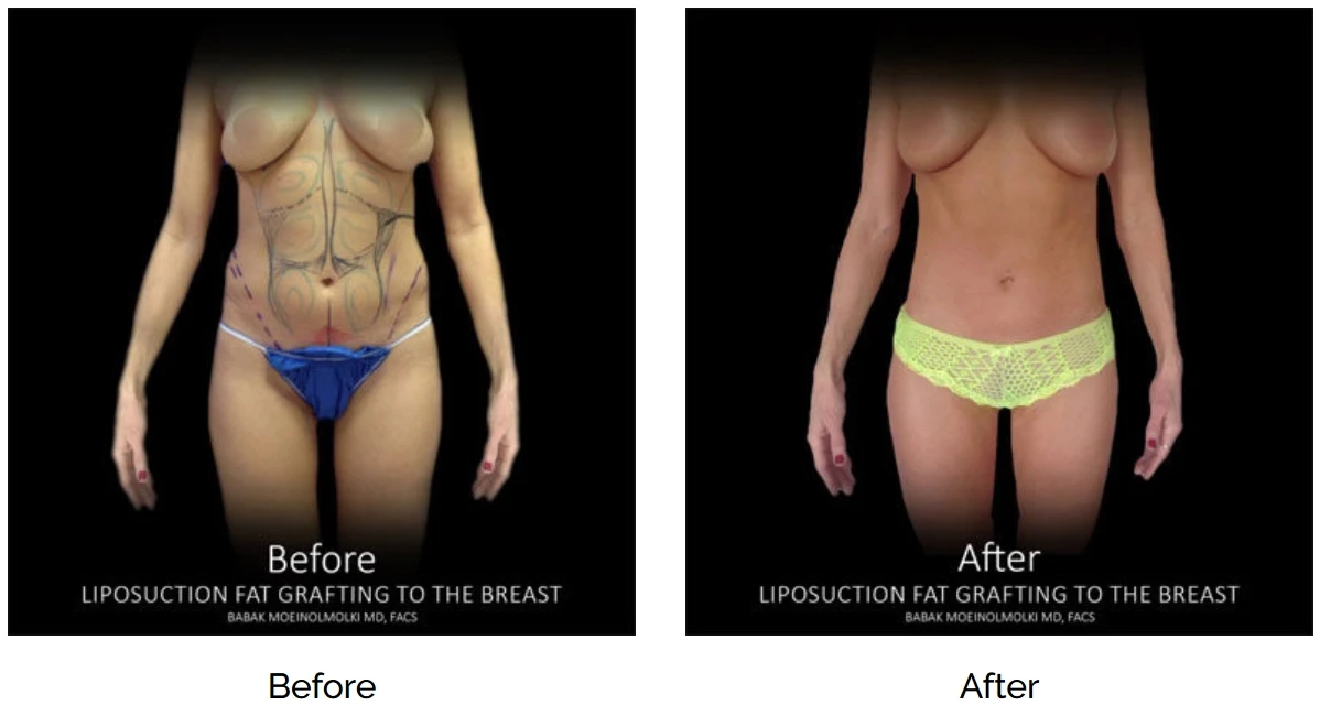 Before and after tummy tuck with liposuction.