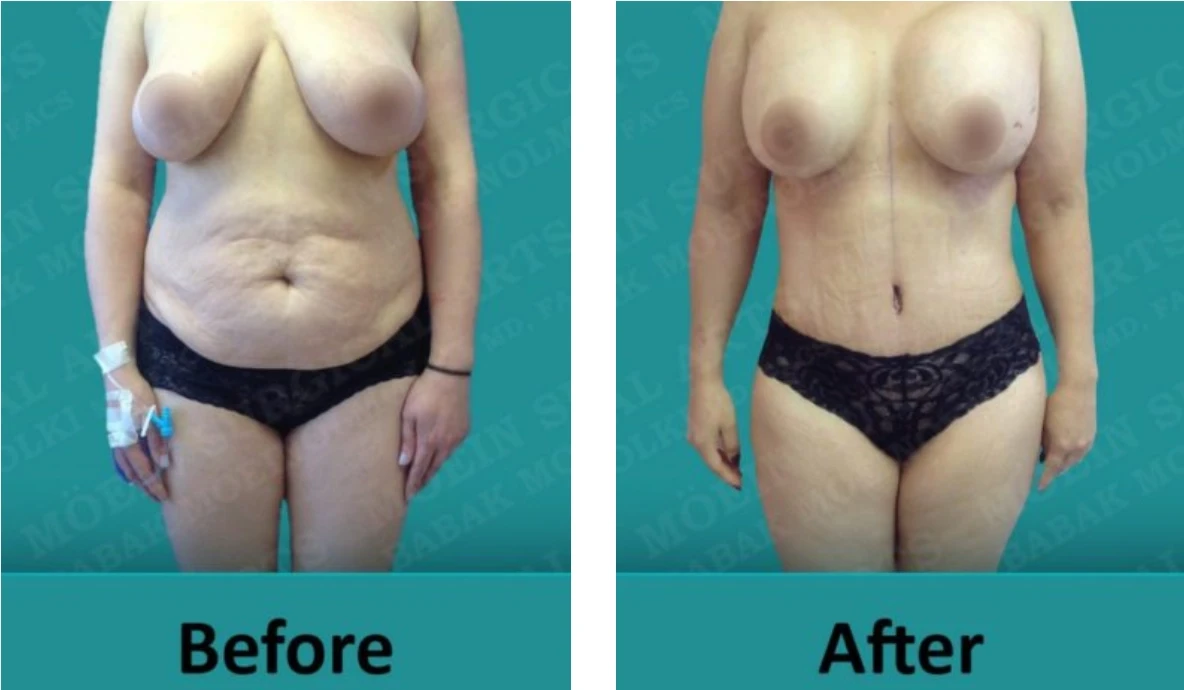 A woman's breasts before and after liposuction.