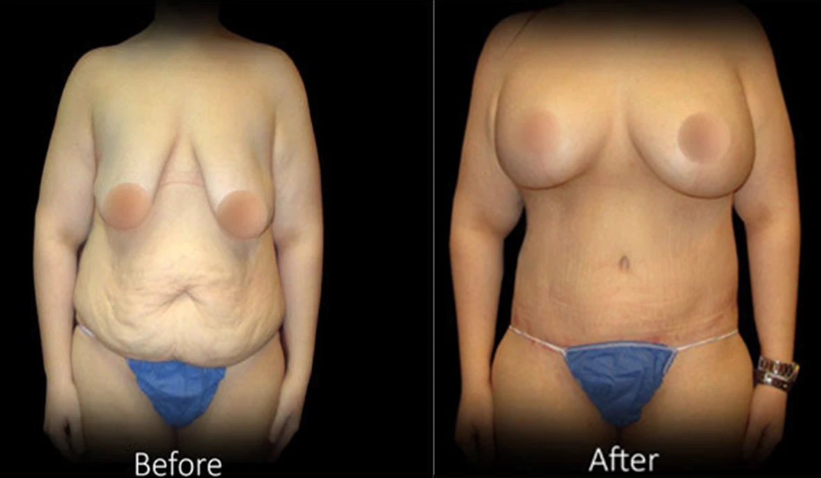 Tummy tuck before and after.