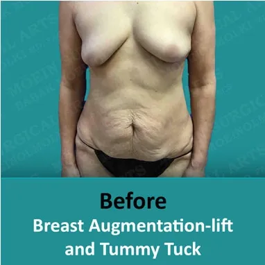 Mommy makeovers showcasing breast augmentation lift and tummy tuck before and after transformations.