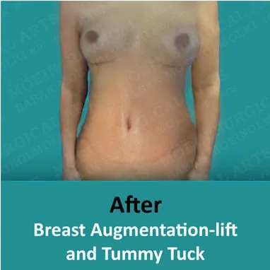 Before and after Mommy Makeovers featuring breast augmentation lift and tummy tuck.